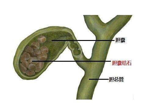 怎么治疗胆结石更好